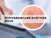 孩子长牛皮癣会有什么症状 孩子得了牛皮皮癣怎么办