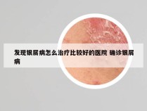 发现银屑病怎么治疗比较好的医院 确诊银屑病