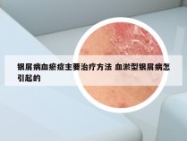 银屑病血瘀症主要治疗方法 血淤型银屑病怎引起的