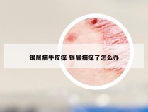 银屑病牛皮痒 银屑病痒了怎么办