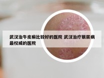 武汉治牛皮癣比较好的医院 武汉治疗银屑病最权威的医院