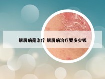 银屑病是治疗 银屑病治疗要多少钱