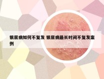 银屑病如何不复发 银屑病最长时间不复发案例