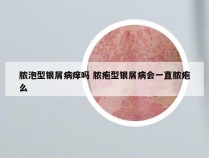 脓泡型银屑病痒吗 脓疱型银屑病会一直脓疱么