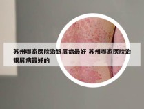 苏州哪家医院治银屑病最好 苏州哪家医院治银屑病最好的