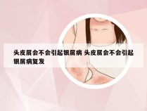 头皮屑会不会引起银屑病 头皮屑会不会引起银屑病复发
