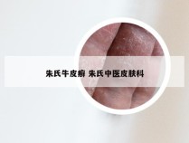 朱氏牛皮癣 朱氏中医皮肤科