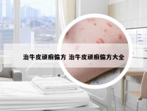 治牛皮顽癣偏方 治牛皮顽癣偏方大全