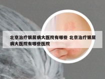 北京治疗银屑病大医院有哪些 北京治疗银屑病大医院有哪些医院