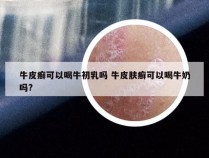 牛皮癣可以喝牛初乳吗 牛皮肤癣可以喝牛奶吗?