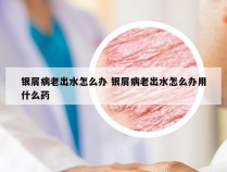 银屑病老出水怎么办 银屑病老出水怎么办用什么药