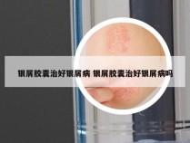 银屑胶囊治好银屑病 银屑胶囊治好银屑病吗