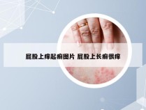 屁股上痒起癣图片 屁股上长癣很痒