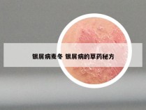 银屑病麦冬 银屑病的草药秘方
