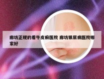 廊坊正规的看牛皮癣医院 廊坊银屑病医院哪家好