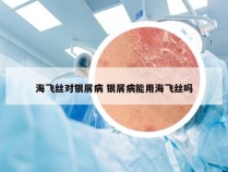 海飞丝对银屑病 银屑病能用海飞丝吗