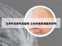 兰州牛皮癣专业医院 兰州市银屑病医院好吗