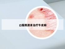 口服类激素治疗牛皮癣