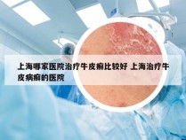 上海哪家医院治疗牛皮癣比较好 上海治疗牛皮病癣的医院