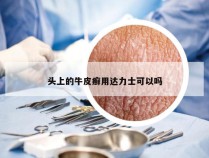 头上的牛皮癣用达力士可以吗