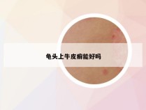 龟头上牛皮癣能好吗