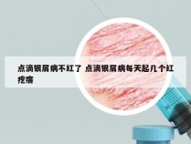 点滴银屑病不红了 点滴银屑病每天起几个红疙瘩