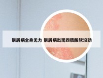 银屑病全身无力 银屑病出现四肢酸软没劲