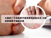 小腿的一小块皮肤干燥发痒发白起白点 小腿皮肤瘙痒干燥起白屑