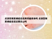 点滴性银屑病痊愈后再切扁条体吗 点滴型银屑病痊愈后还要忌口吗