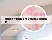 银屑病治疗会有反复 银屑病治疗期间病情反复