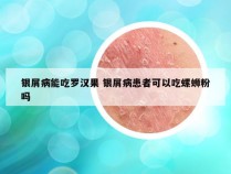 银屑病能吃罗汉果 银屑病患者可以吃螺蛳粉吗