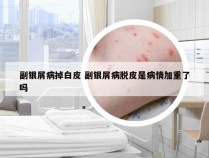 副银屑病掉白皮 副银屑病脱皮是病情加重了吗