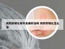 丙肝肝硬化和牛皮癣好治吗 丙肝肝硬化怎么治