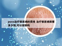 puva治疗银屑病的费用 治疗银屑病需要多少钱,可以报销吗