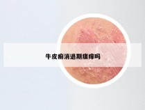 牛皮癣消退期瘙痒吗