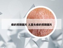癣的初期图片 儿童头癣的初期图片