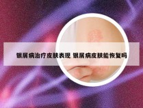 银屑病治疗皮肤表现 银屑病皮肤能恢复吗