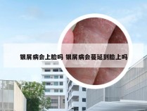 银屑病会上脸吗 银屑病会蔓延到脸上吗