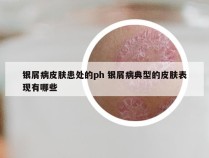 银屑病皮肤患处的ph 银屑病典型的皮肤表现有哪些