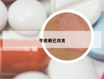 牛皮癣已攻克