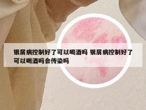 银屑病控制好了可以喝酒吗 银屑病控制好了可以喝酒吗会传染吗