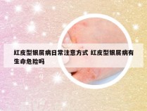 红皮型银屑病日常注意方式 红皮型银屑病有生命危险吗