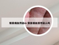 银屑病血传染m 银屑病血液传染人吗