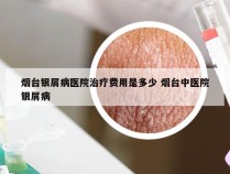 烟台银屑病医院治疗费用是多少 烟台中医院银屑病