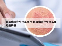 银屑病治疗中什么图片 银屑病治疗中什么图片最严重
