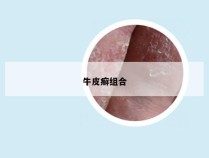 牛皮癣组合