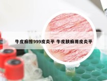 牛皮癣擦999皮炎平 牛皮肤癣用皮炎平