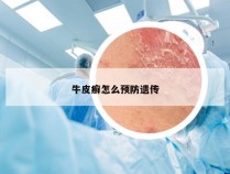 牛皮癣怎么预防遗传