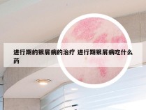进行期的银屑病的治疗 进行期银屑病吃什么药