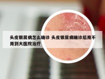 头皮银屑病怎么确诊 头皮银屑病确诊后用不用到大医院治疗